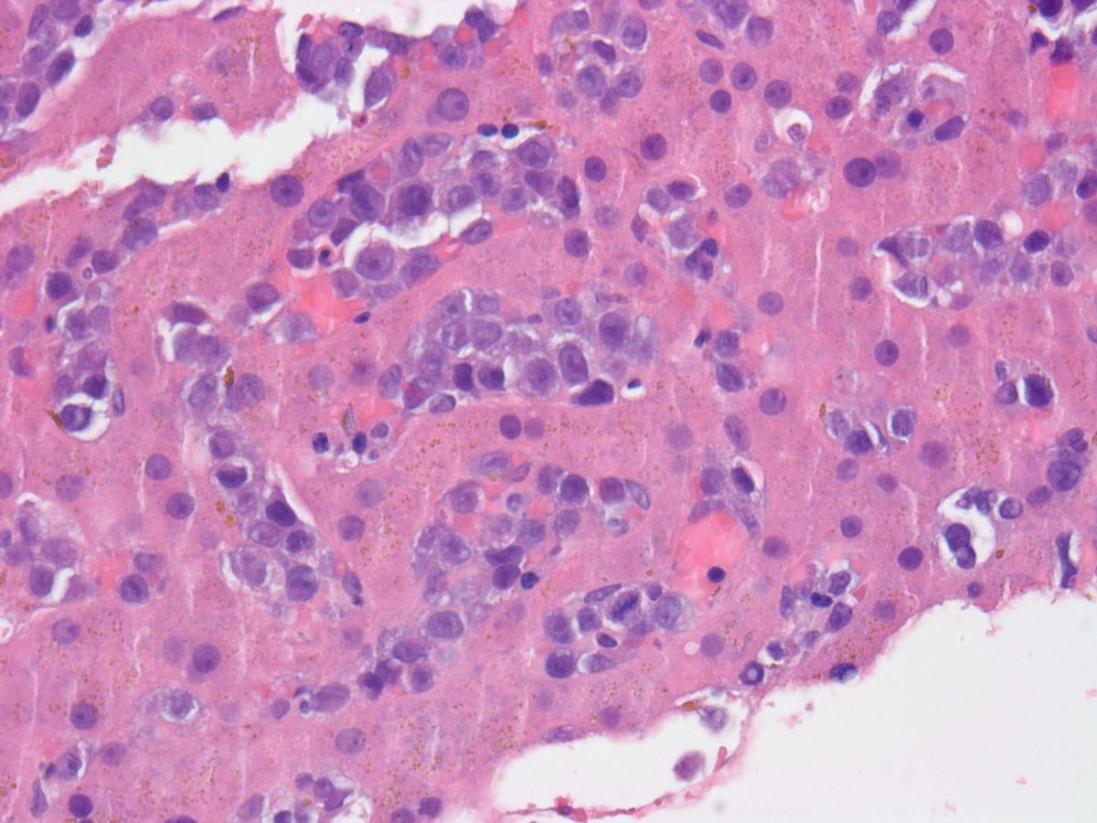 Liver: Sinusoidal infiltration of proerythroblast population